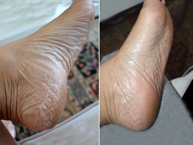 Original Foot Peel and Men's Foot Peel