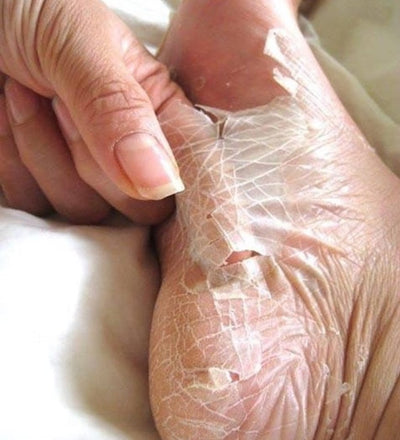 Peeling foot result